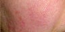 Photofacial
