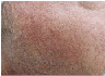 Photofacial/IPL