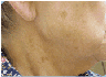 photofacial