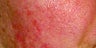 Photofacial