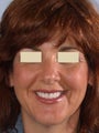 Porcelain Veneers and Porcelain Crowns