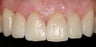 Veneers
