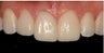Minimal-Prep Veneers