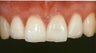 Porcelain Veneers