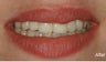 Porcelain Veneers