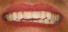 Tooth bleaching and porcelain veneer