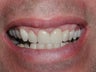Porcelain Veneers, Crowns, Teeth Whitening, and Gummy Smile Repair