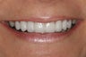 Smile Makeover with Minimal-Prep Porcelain Veneers