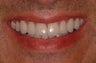 Complete Smile Makeover