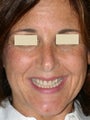 Porcelain Veneers and Porcelain Crowns