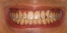 DURAthin minimal preparation porcelain veneers