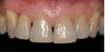 Veneers