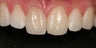 Minimal-Prep Veneers