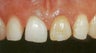 Porcelain Veneers