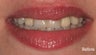 Porcelain Veneers