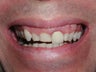 Porcelain Veneers, Crowns, Teeth Whitening, and Gummy Smile Repair