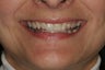 Smile Makeover with Minimal-Prep Porcelain Veneers