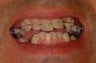Complete Smile Makeover