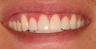 Veneers and teeth whitening