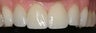 Porcelain Veneers