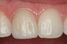 Single Tooth Veneer