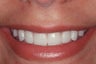 Porcelain Veneers