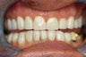 Porcelain Veneers
