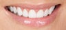Gum re-contouring and porcelain veneers