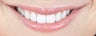 Gum re-contouring and porcelain veneers