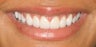 Gum re-contouring and porcelain veneers