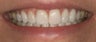 Porcelain crowns and porcelain veneers