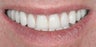Porcelain crowns and porcelain veneers