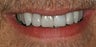 Porcelain veneers