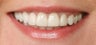 Orthodontics, all porcelain veneers