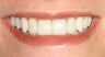Orthodontics, all porcelain veneers