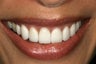 Porcelain veneers