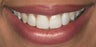 Porcelain veneers