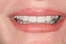 Porcelain veneers