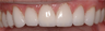 Porcelain Veneers