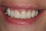 Vaneers and whitening
