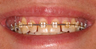 Veneers and teeth whitening
