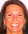 Porcelain veneers