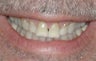 Porcelain Veneers