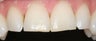 Porcelain Veneers