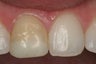Single Tooth Veneer