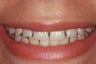Porcelain Veneers