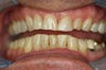 Porcelain Veneers