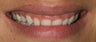 Gum re-contouring and porcelain veneers