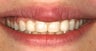 Gum re-contouring and porcelain veneers