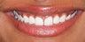 Gum re-contouring and porcelain veneers